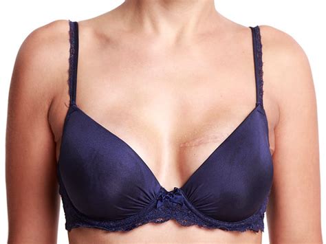 Flap Vs Implant For Breast Reconstruction How To Choose Medpage Today