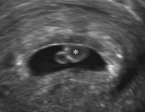 Clinical Significance Of First‐trimester Chorionic Bumps A Matched