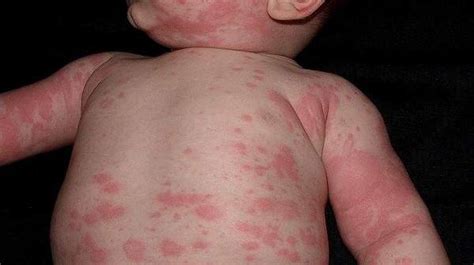 5 Common Skin Conditionsrashes In Babieschildren Kids Clinic