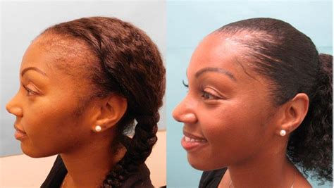 Traction Alopecia Hair Transplant A Solution For Hair Loss Lalma