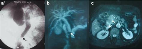 A An Endoscopic Retrograde Cholangiopancreatography Image Shows An