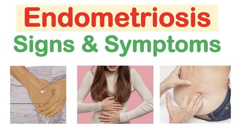 Endometriosis Signs And Symptoms And Why They Occur Youtube In 2023