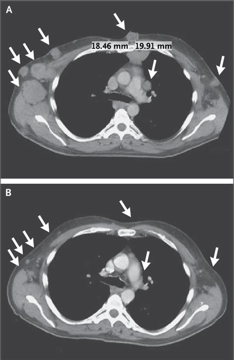 Computed Tomographic Ct Scans Of The Chest Showing Tumor Regression