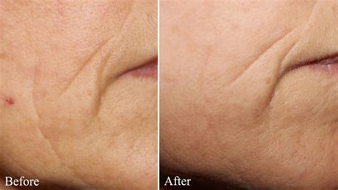 Removing Wrinkles In 7 Days With This Natural Recipe