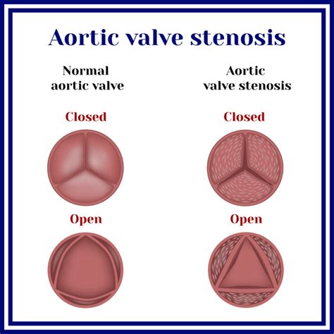 How Many People Over 65 Have Aortic Valve Stenosis Scary Symptoms