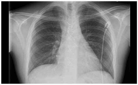 Aortic Valve Replacement X Ray