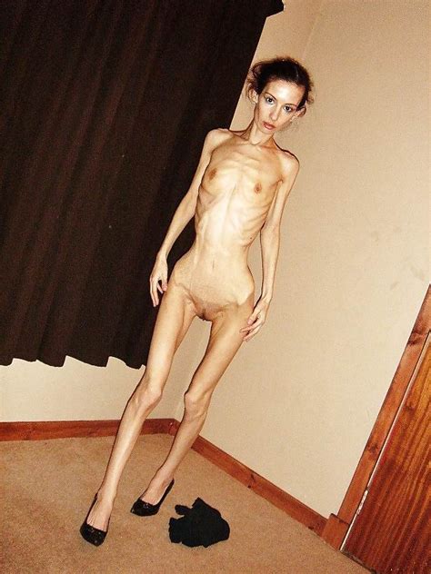 Anorexic Model Shows Off Her Perfect Body Sickjunk Com