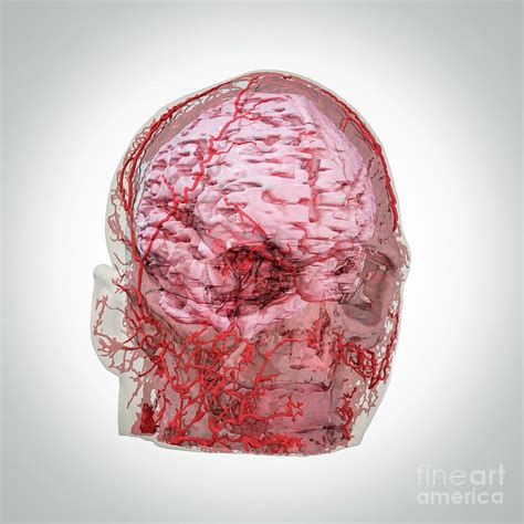 Human Head And Brain Blood Vessels Photograph By Scott Birch