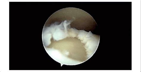 Arthroscopic Photograph Of The Left Ankle After Debridement Of The