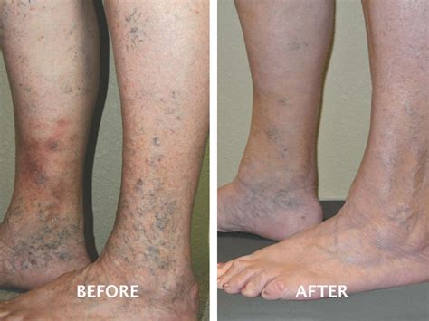 Varicose Vein Treatment Gallery Advanced Vein Therapy