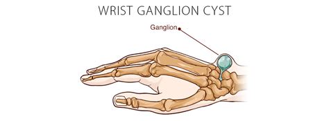 Wrist Ganglion Cyst Orlando Hand Surgery Associates