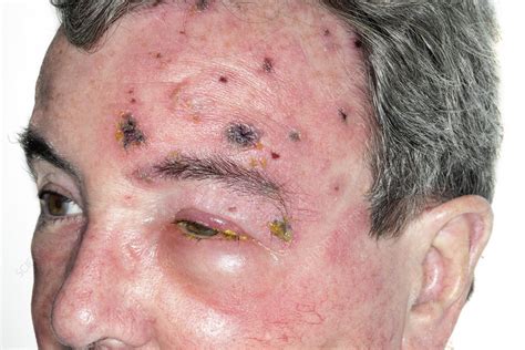 Shingles Rash On The Face Stock Image C0213403 Science Photo Library