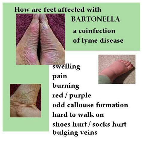 Bartonella Lyme Disease Awareness Lyme Disease Treatment Disease