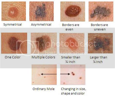 Skin Cancer Orange Coast Dermatology Mission Viejo Rancho Santa