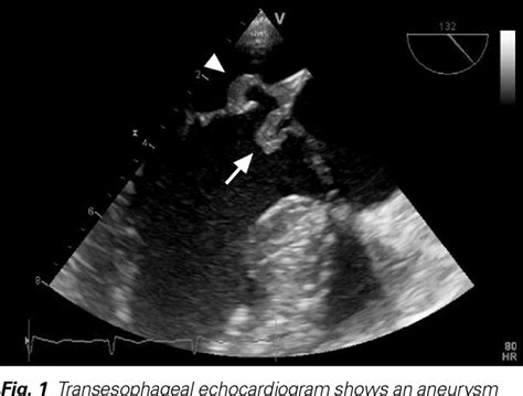 Figure From Infective Endocarditis Of The Aortic Valve With Anterior