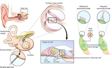 Gene Therapy Restores Hair Cell Stereocilia Morphology In Inner Ears Of