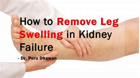 How To Remove Leg Swelling In Kidney Failure Youtube