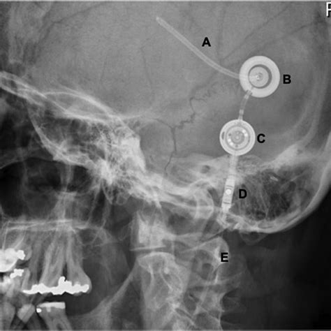 Lateral Skull X Ray Confirming A Ventricular Shunt Including The