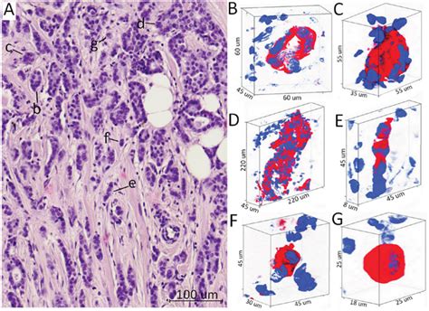 Clinically Relevant Morphological Structures In Breast Cancer Represent