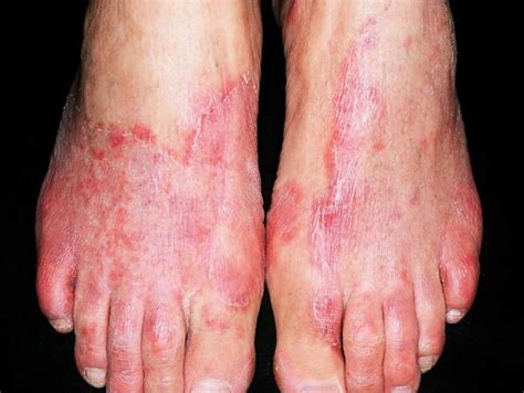 Tinea Pedis Athlete S Foot Causes Symptoms Diagnosis Treatment
