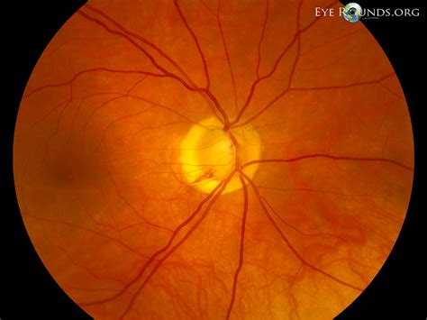 Eyerounds Photo Quiz 1 The University Of Iowa Ophthalmology