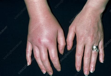 Womans Swollen Hand Due To Infected Insect Sting Stock Image M320