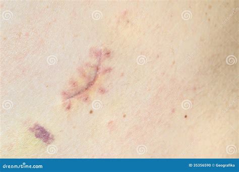 Close Up Of A Fresh Scar On A Male Back Stock Photo Image Of