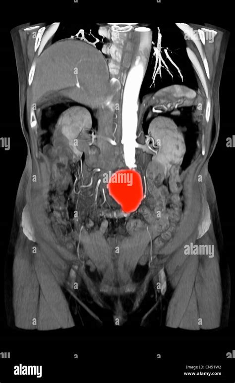 Ct Scan Images Showing An Abdominal Aortic Aneurysm Stock Photo Alamy