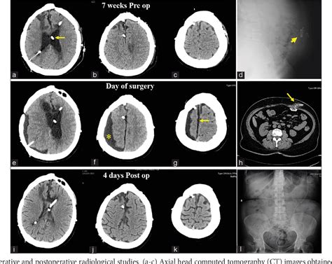 Figure 1 From Subdural Fluid Accumulation Caused By Ventriculoperitoneal Shunt Underdrainage A