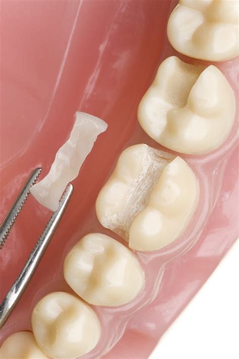 5 Facts About Dental Inlays And Onlays Channo Dds
