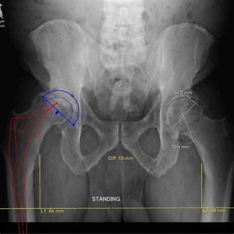 Pre Operative Anteroposterior Hip Radiograph With Templated Surgical