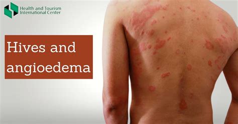Urticaria What Causes A Skin Reaction Hti Centers Medical
