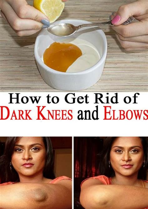 How To Get Rid Of Dark Elbows And Knees Naturally