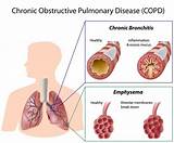 Can You E Ercise With Copd Photos