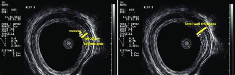 Eus Images Obtained Using An Olympus Miniprobe From Normal Appearing