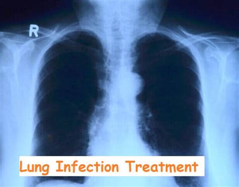 4 Lung Infection Treatment Definition Types And Symptoms