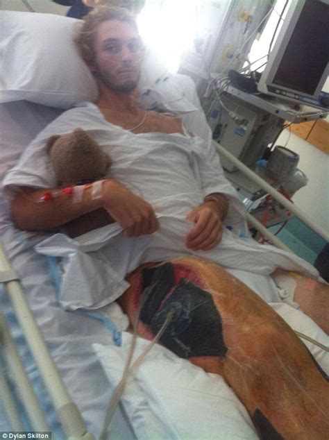 Surfers Leg Swelled To Four Times Its Normal Size After Playing Limbo