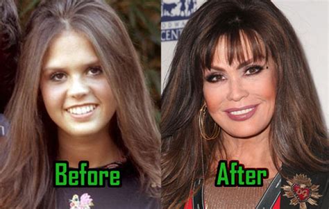 Marie Osmond Plastic Surgery Facelift Nose Job Before After