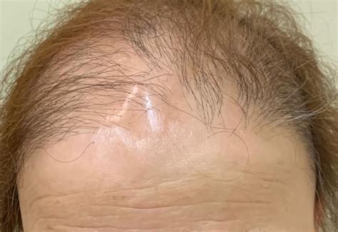 Woman With Lichen Planopilaris Wants A Hair Transplant Photo