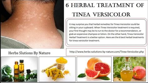 6 Herbal Treatment Of Tinea Versicolor Herbssolutionsbynature Medium