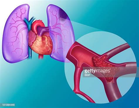 Pulmonary Embolism Photos And Premium High Res Pictures Getty Images