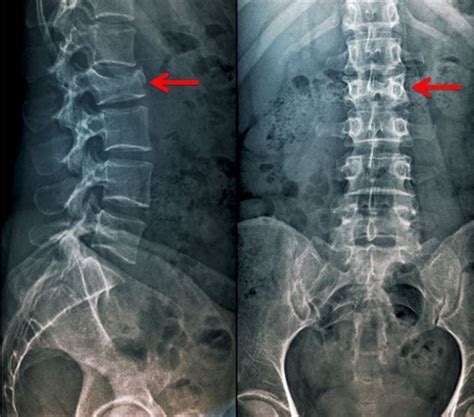 Image Anteroposterior And Lateral View Of A Compression Fracture Msd