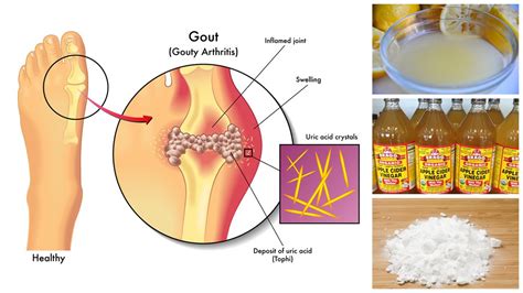 Some of the foods that increase uric acid levels include meat, poultry and seafood, baked foods, alcohol and soft drinks, high fat diet and certain vegetables like spinach, corn, mushrooms cauliflower etc. How to Lower Uric Acid Naturally - YouTube