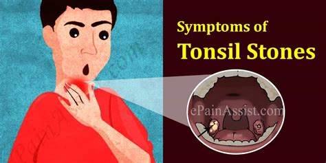Tonsil Stones Everything You Need To Know