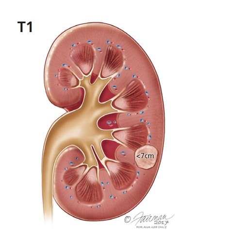 Renal Mass And Localized Renal Tumors Symptoms Diagnosis And Treatment