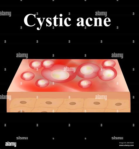 Cyst Acne Acne On The Skin Of A Cyst Dermatological And Cosmetic