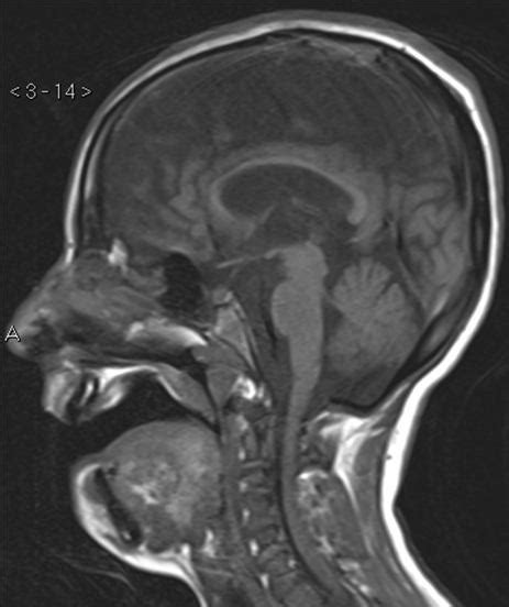 Magnetic Resonace Imaging Findings In A Case Of Infantile Refsum