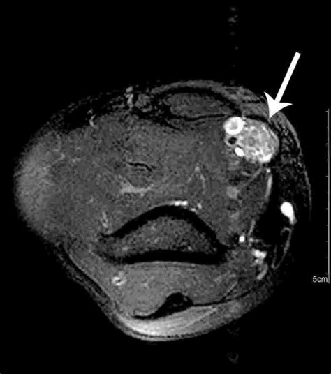 Axial Fat Suppressed T2 Weighted Mri Shows A Tumorous Lesion Of The