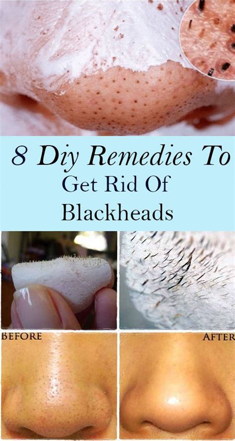 8 Diy Remedies To Get Rid Of Blackheads In 2020 Diy Remedies Get Rid