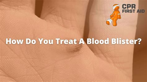 How Do You Treat A Blood Blister Cpr First Aid